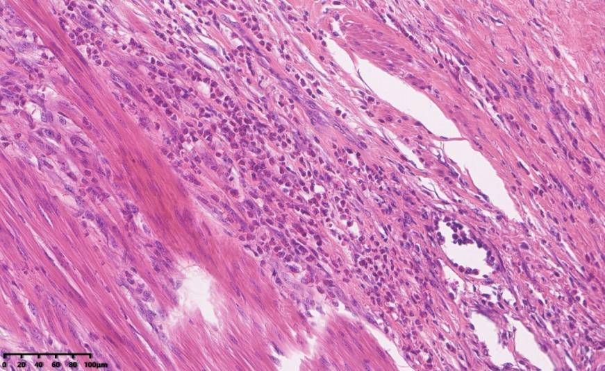 高分化鳞状细胞癌能活多久