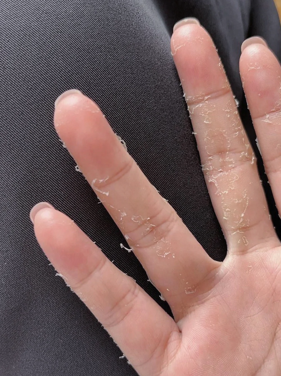 手指脱皮,开裂什么原因