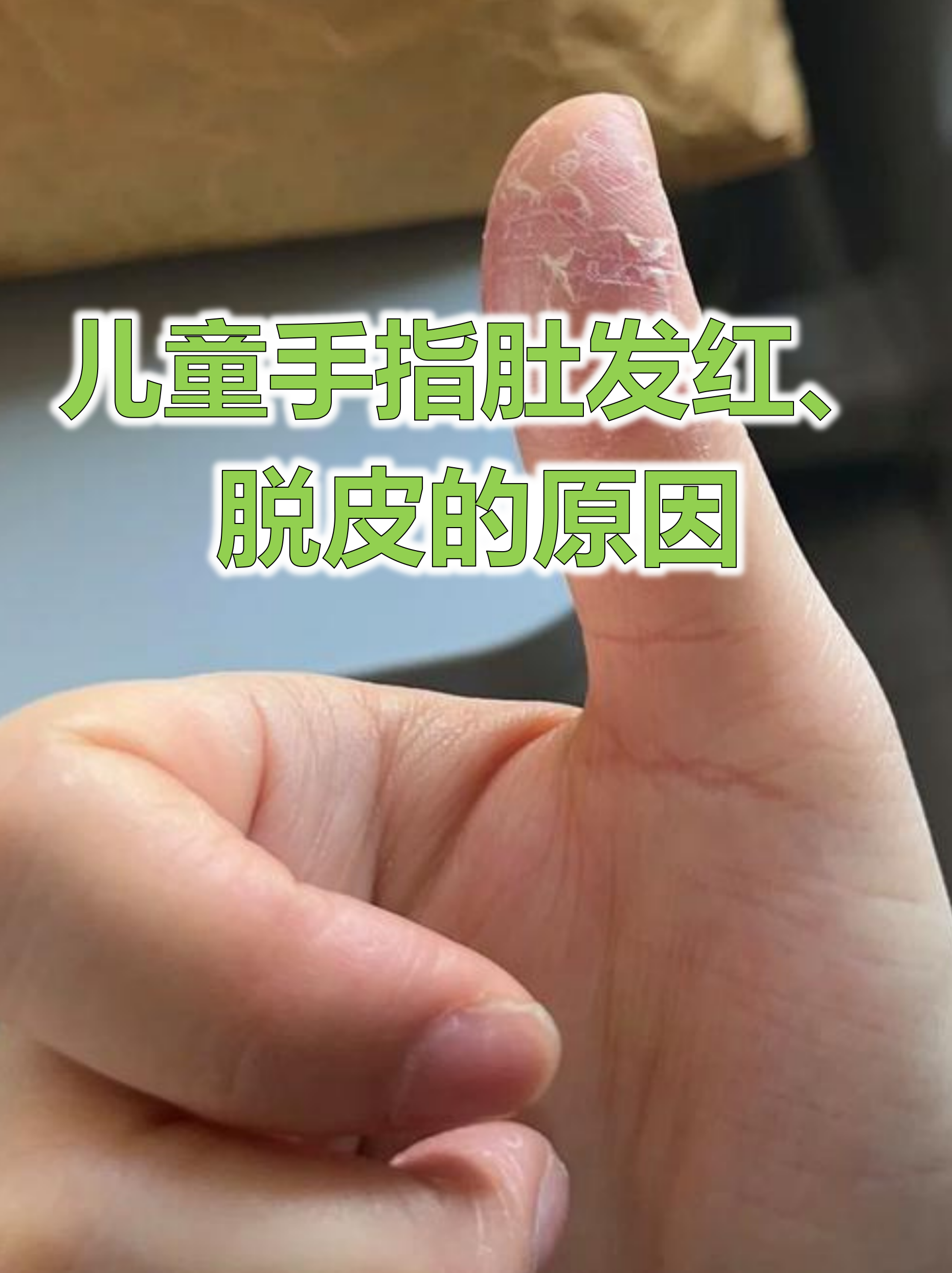 手指脱皮,开裂什么原因
