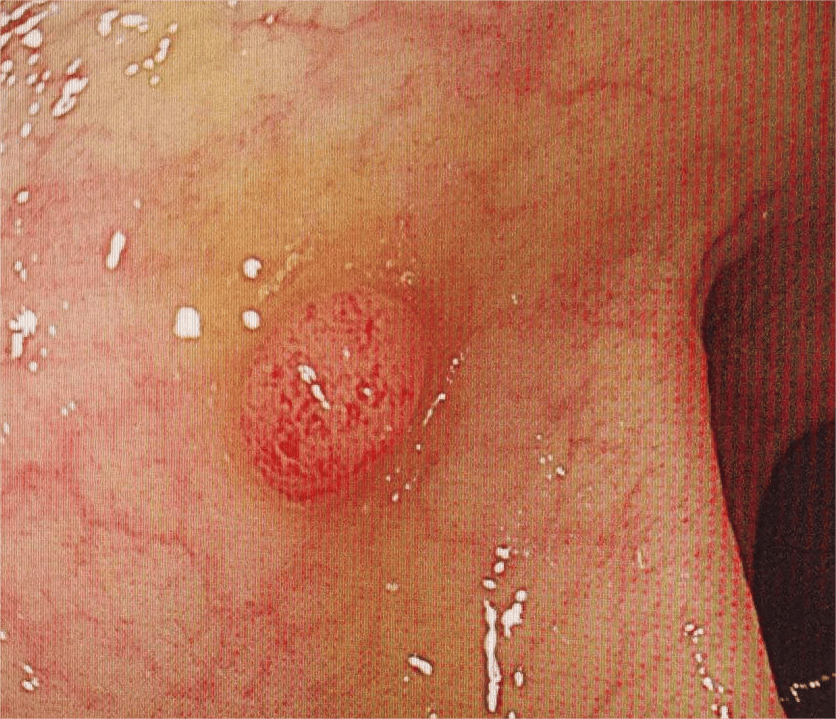 肠子长息肉有什么症状