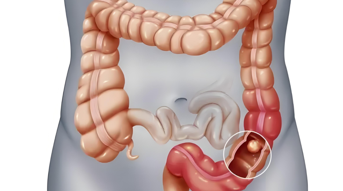 肠子长息肉有什么症状