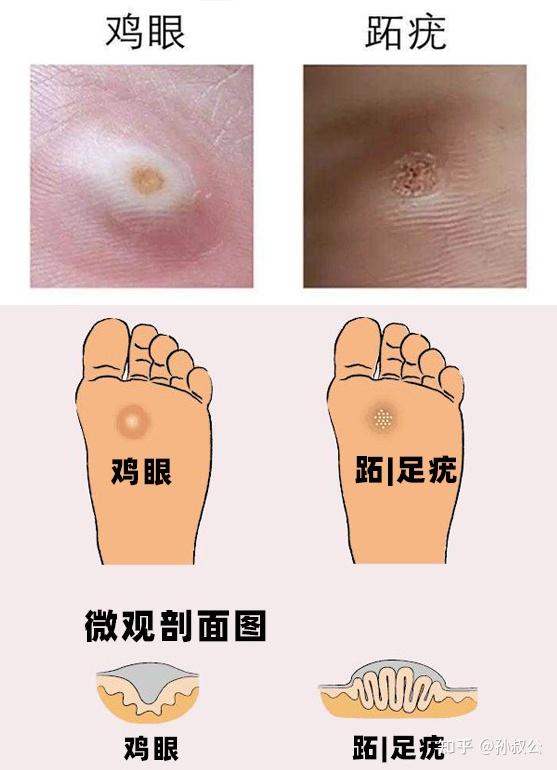 鸡眼怎么形成的