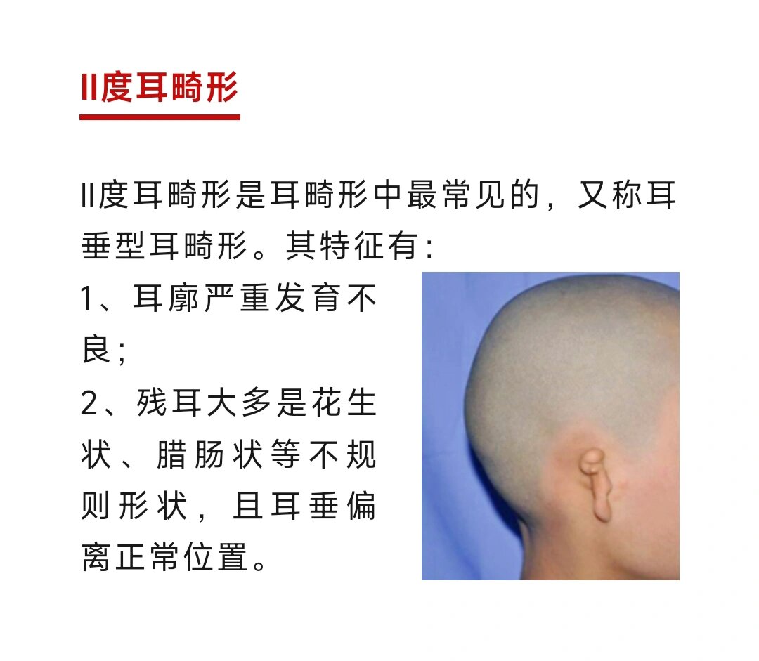 耳廓畸形有哪些情况