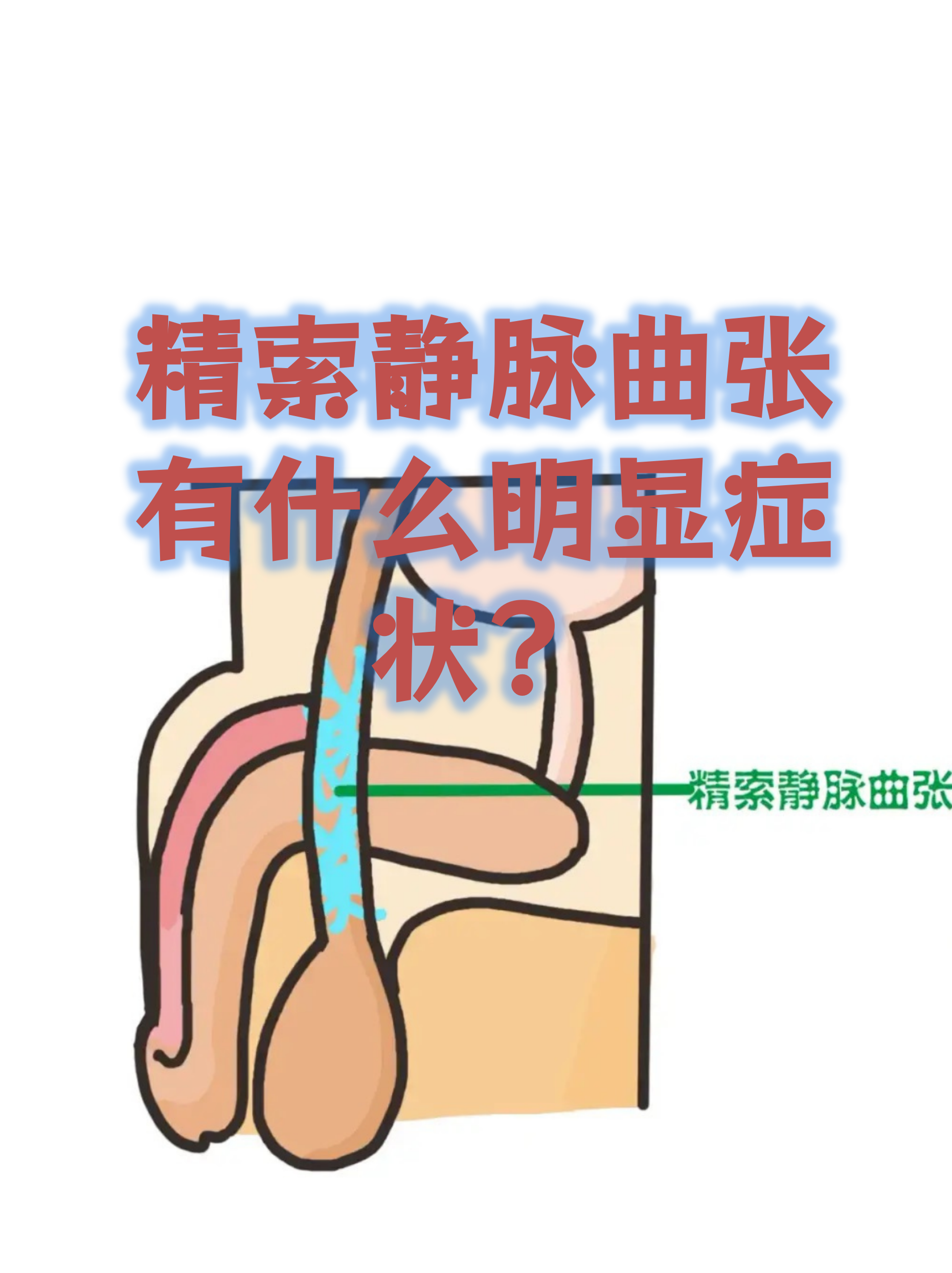 睾丸静脉曲张症状?