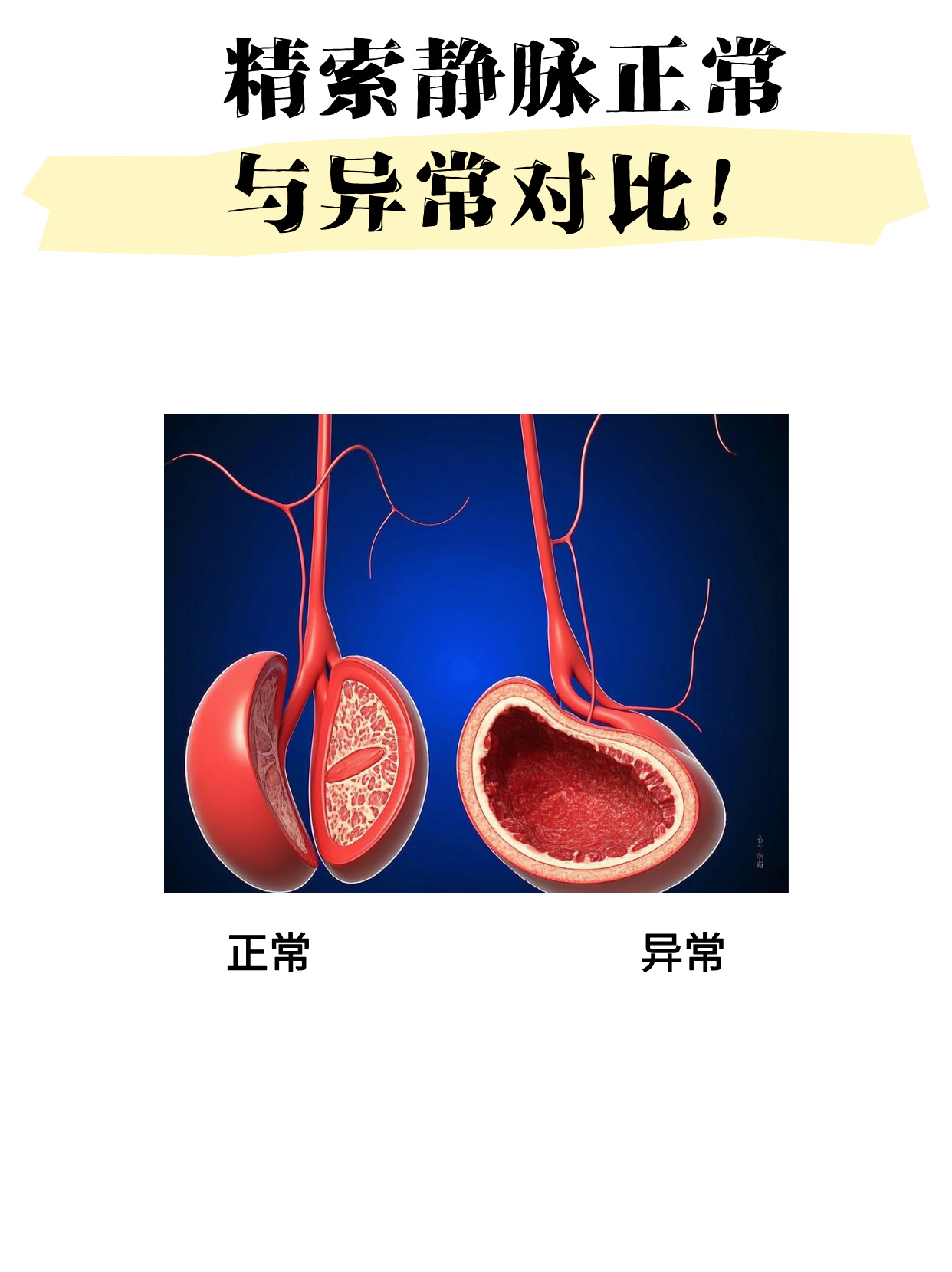 睾丸静脉曲张症状?