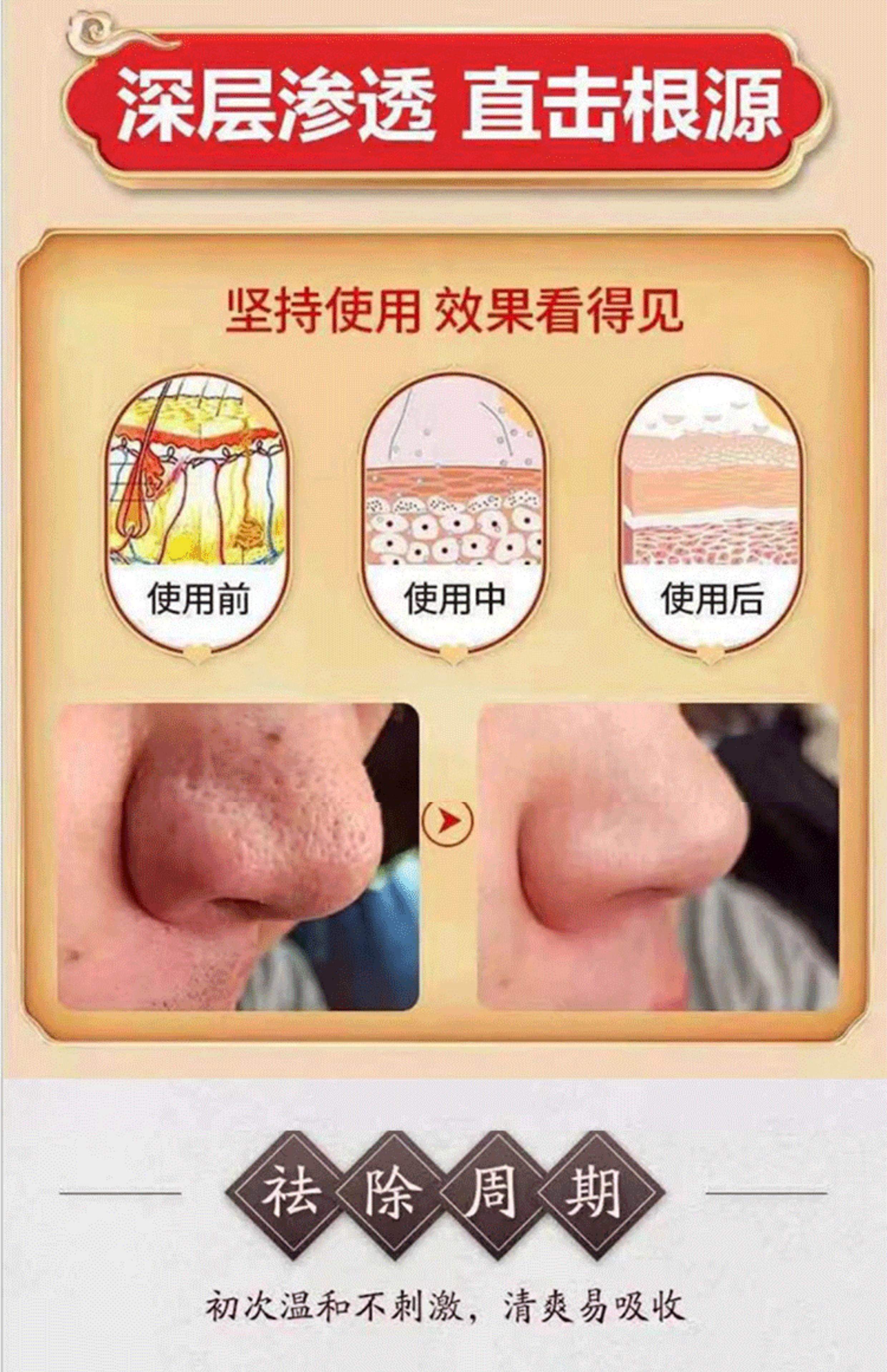 如何治疗酒糟鼻