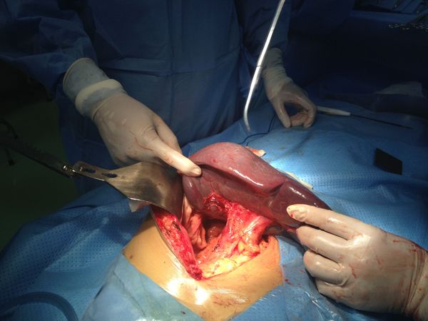 脾切除后多久才能恢复