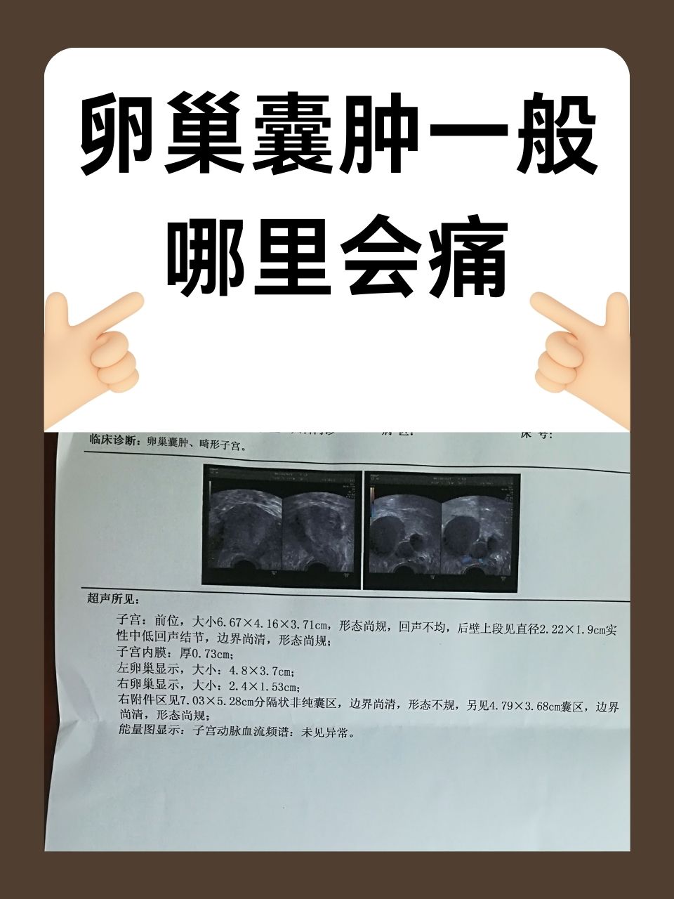 子宫囊肿,后果严重吗