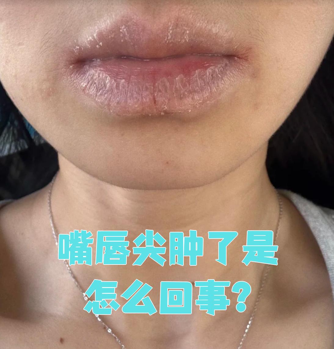 嘴唇为什么突然肿了