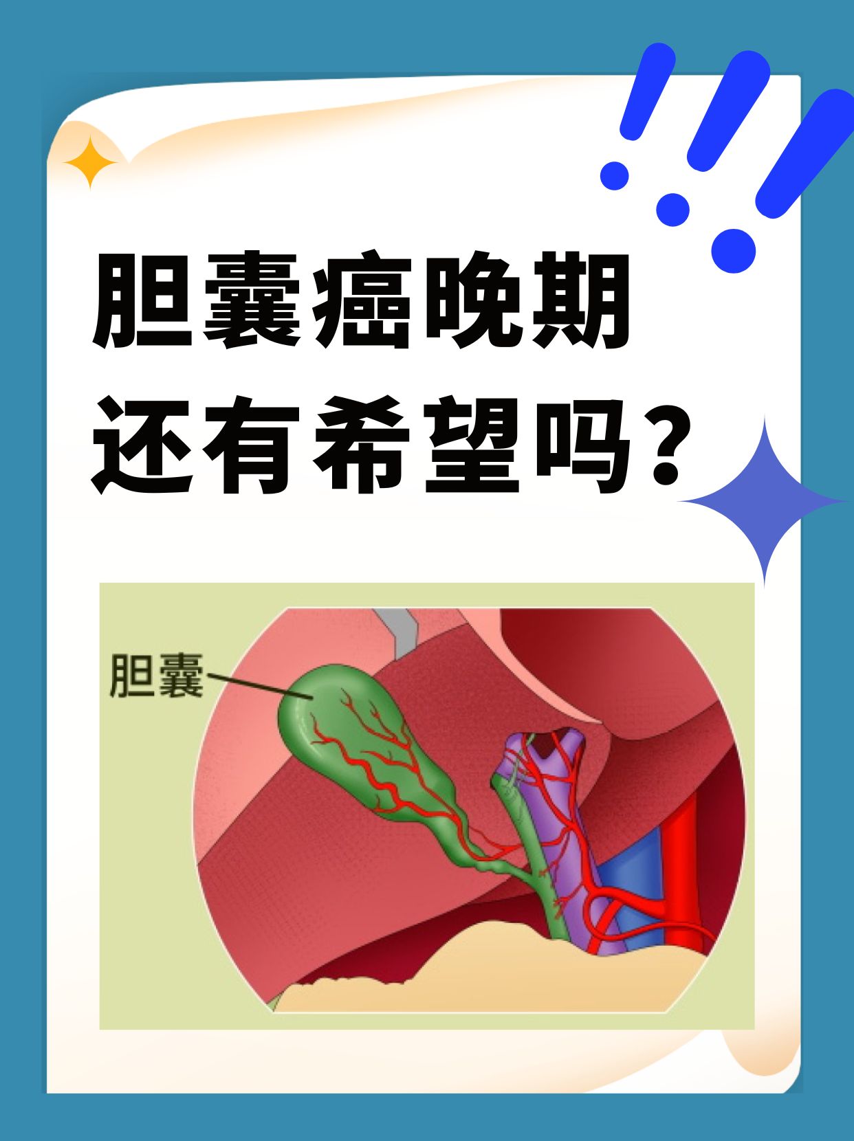 胆管癌的早期症状表现