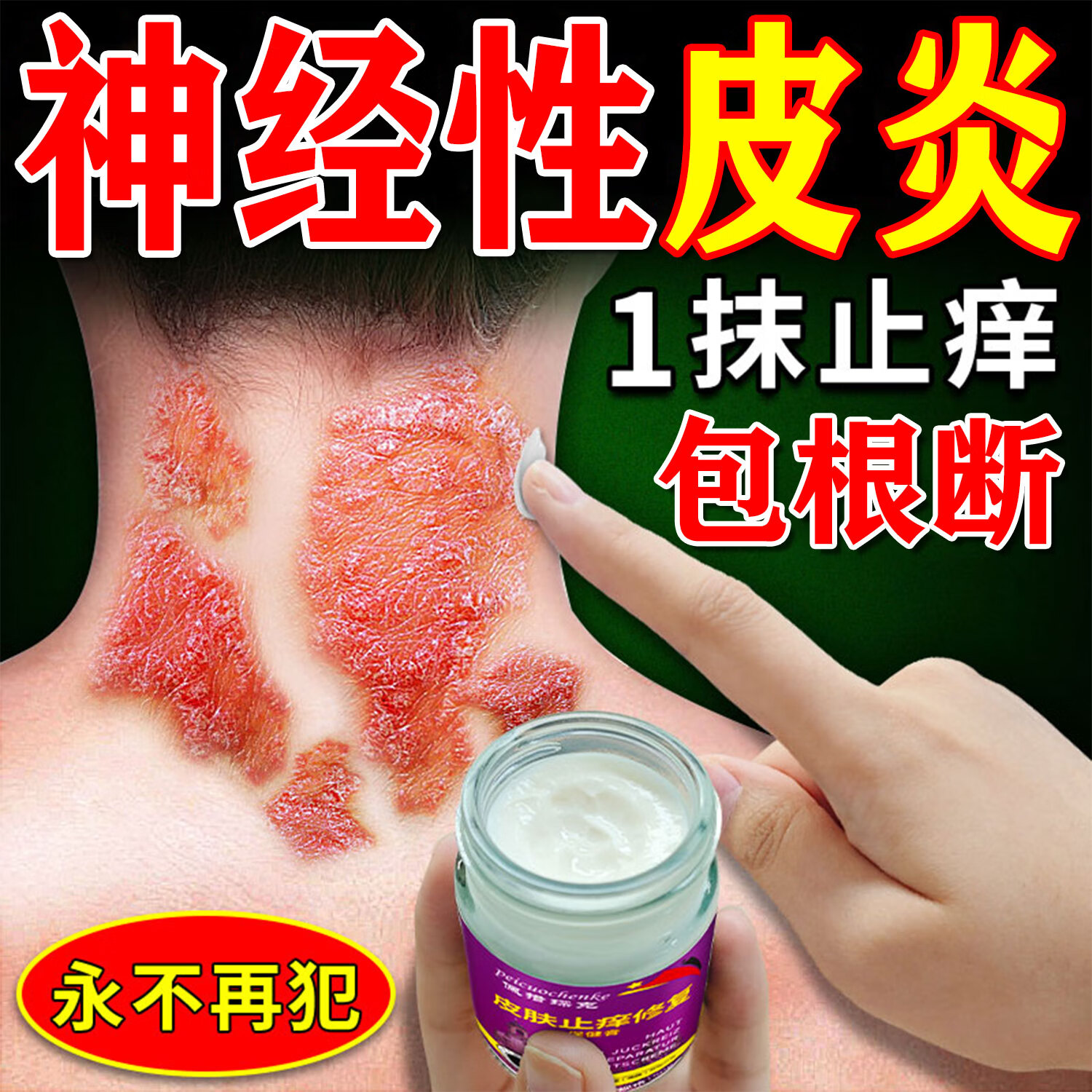 皮炎湿疹的治疗