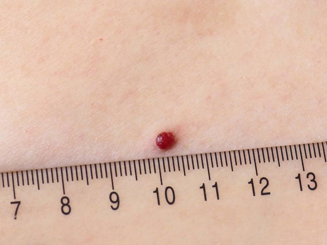 身上长很多小红痣是什么原因