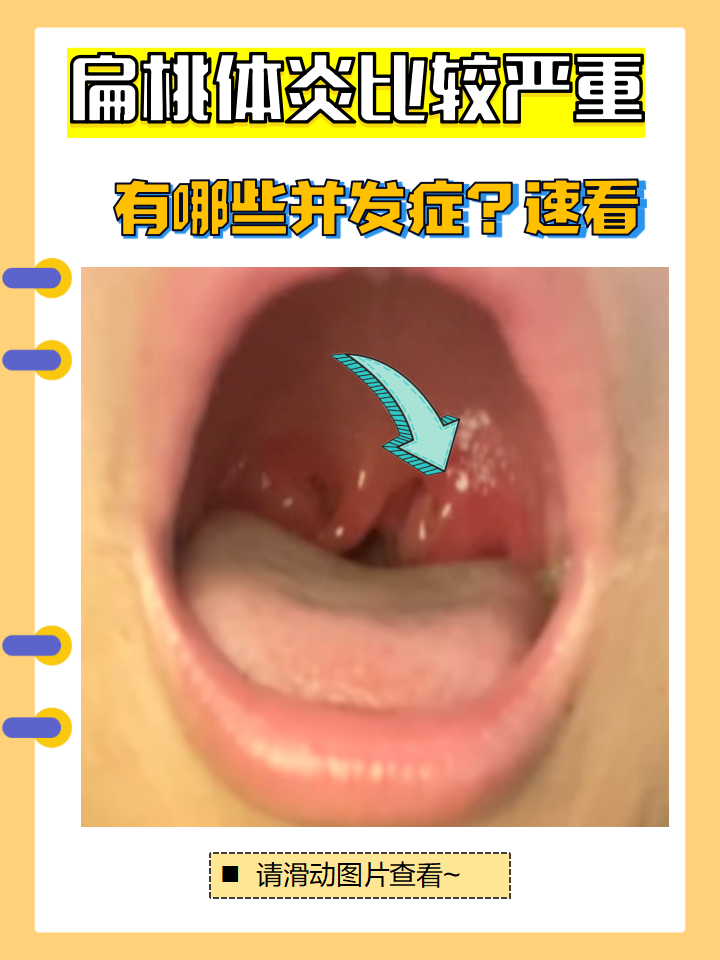 急性扁桃体炎多久能好