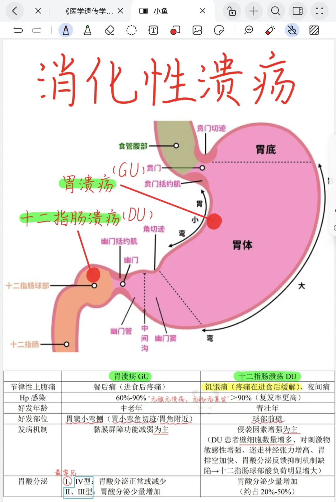 胃溃疡和十二指肠溃疡的区别