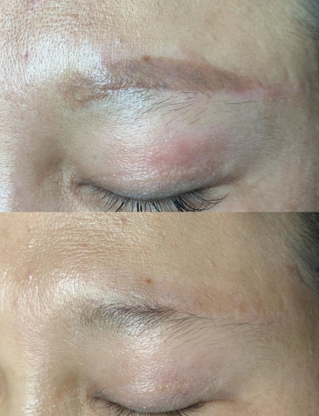 眉毛刮光了能长出来吗