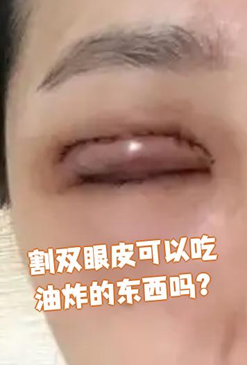 割了双眼皮后不能吃哪些东西