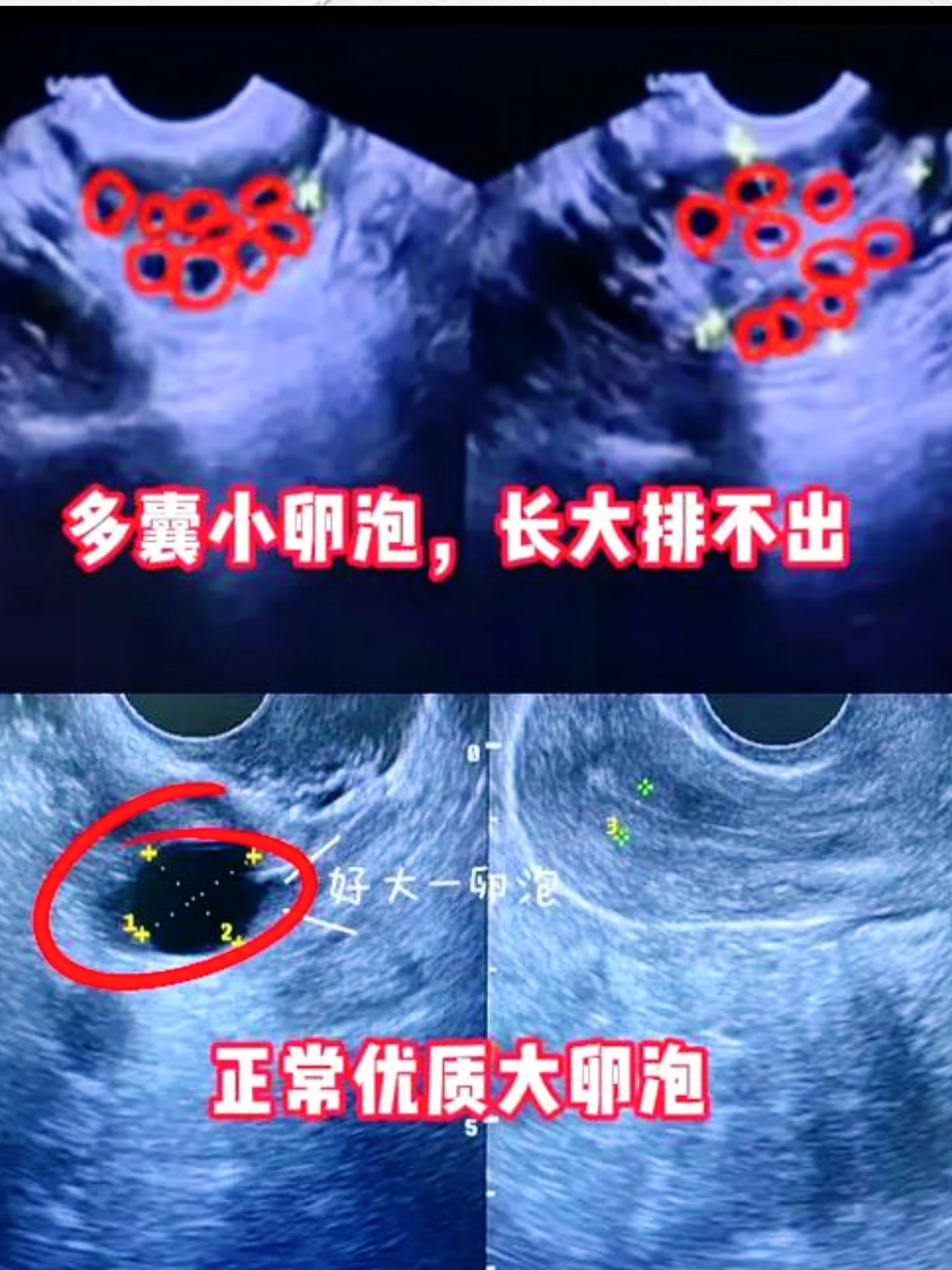 没有优势卵泡,可以怀孕吗?