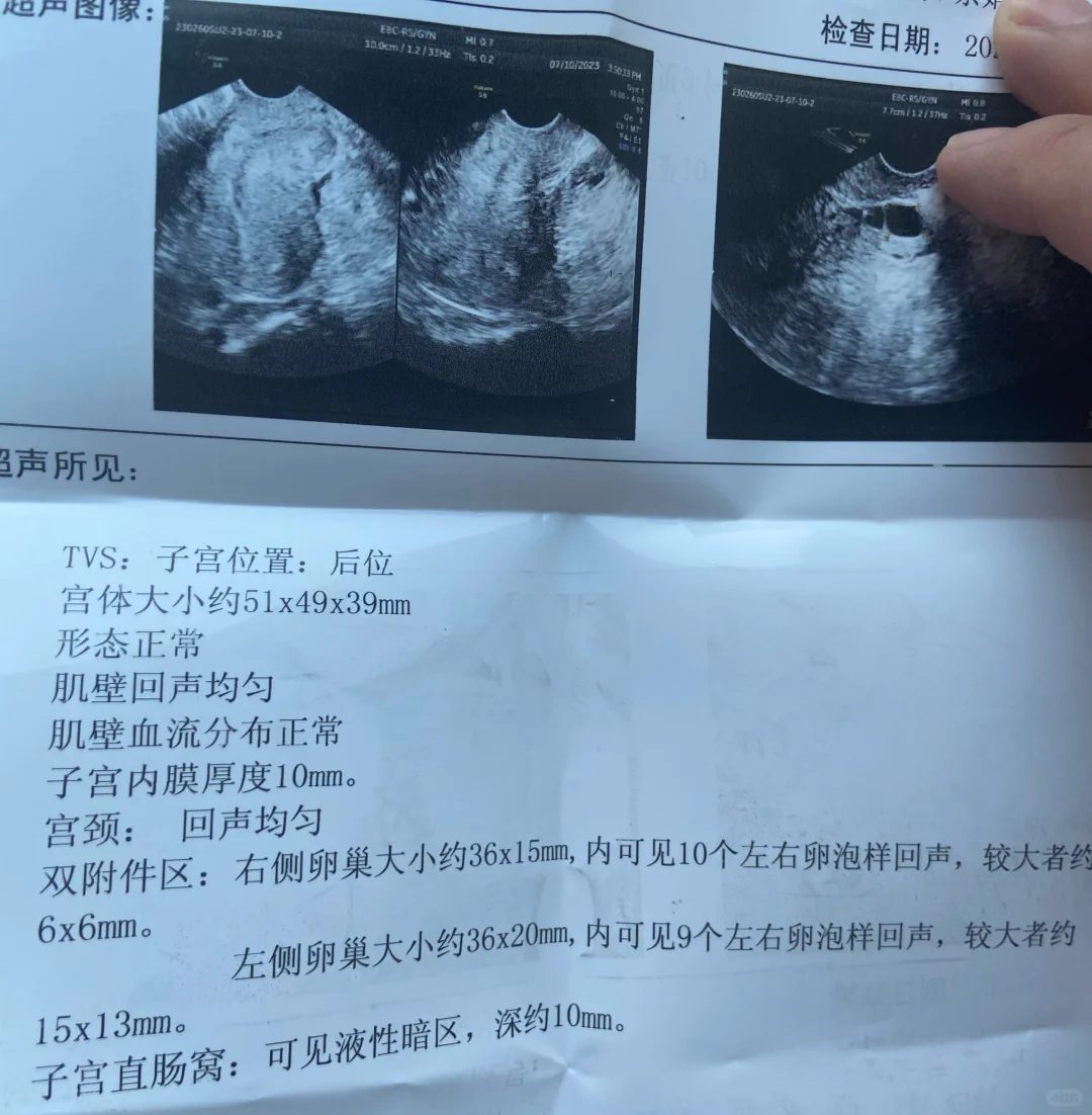 没有优势卵泡,可以怀孕吗?