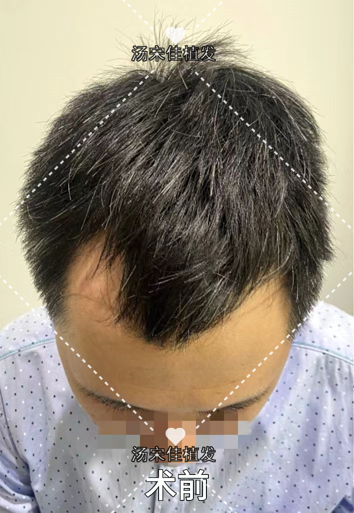 能导致发际线后移的原因是什么?