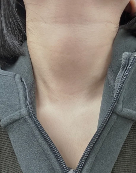 甲状腺肿的主要症状表现?