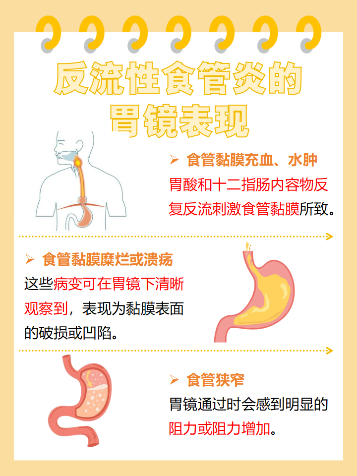 反流性食管炎如何分级