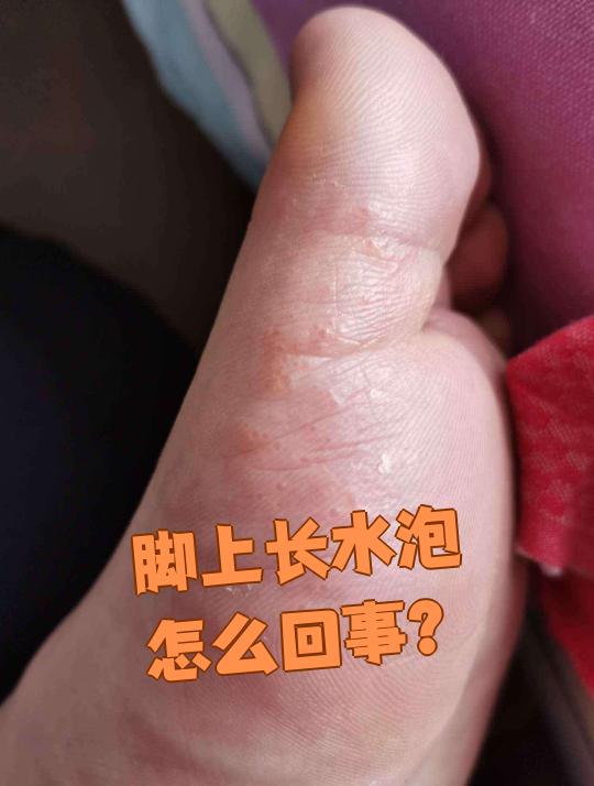 脚底有水泡怎么回事.