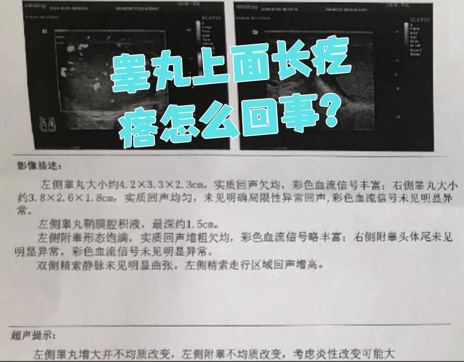 睾丸上有小疙瘩是怎么回事