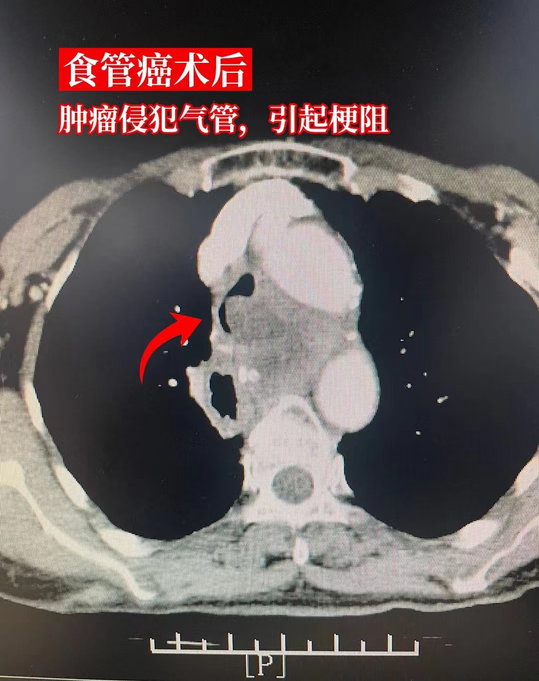 食道癌晚期能活多久?
