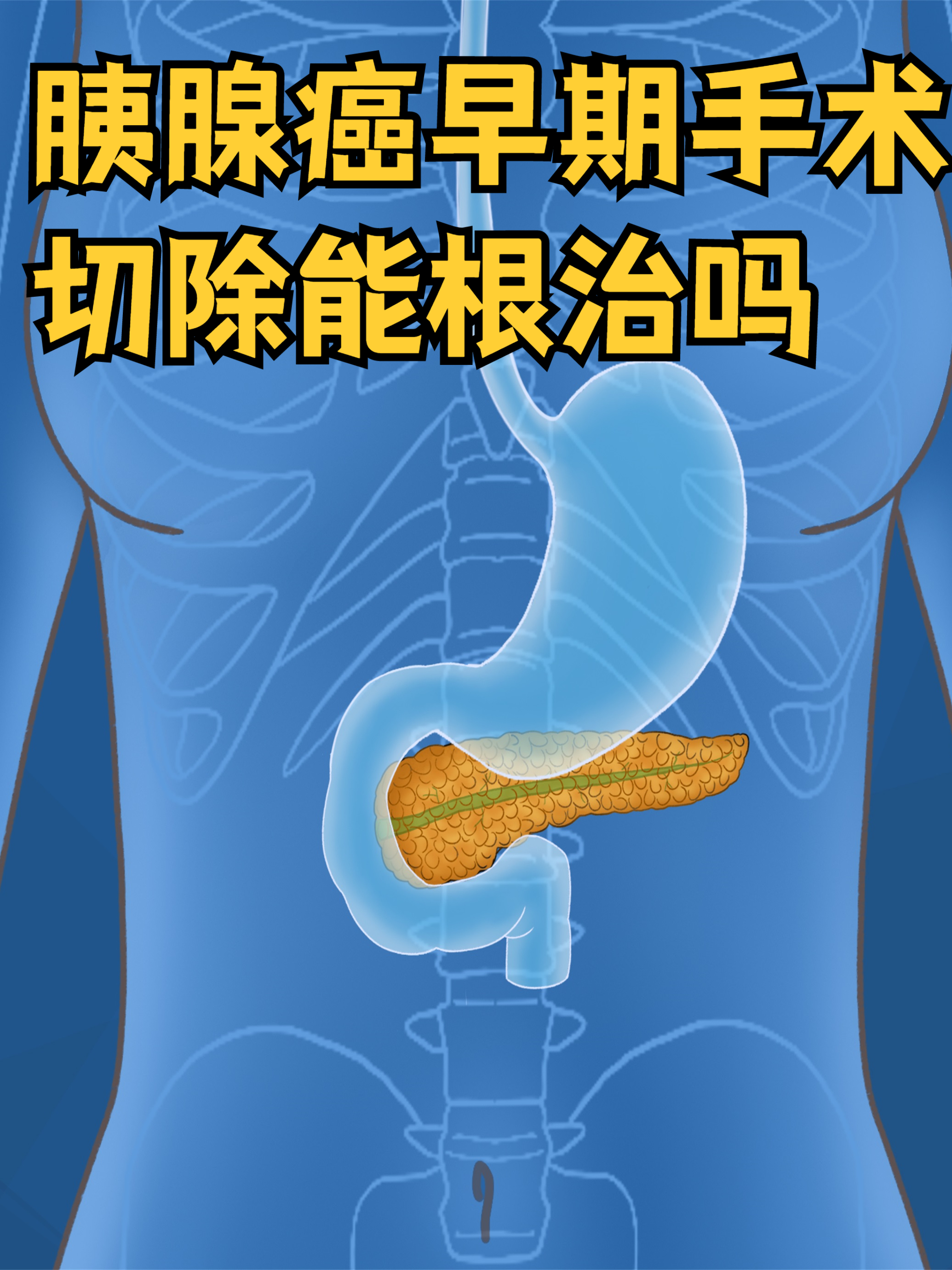 胰腺癌能治好吗?