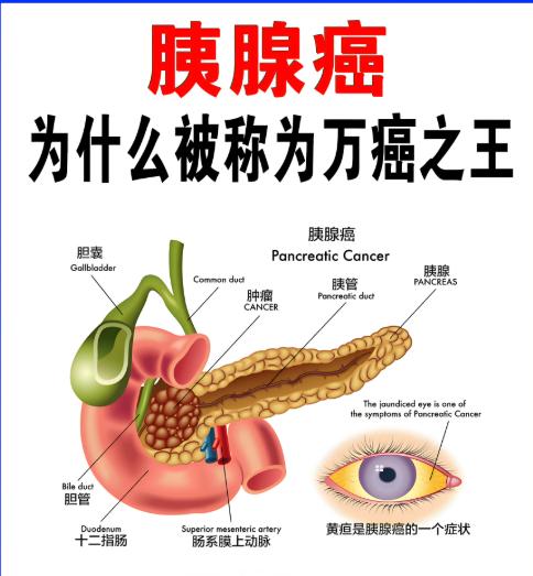 胰腺癌能治好吗?