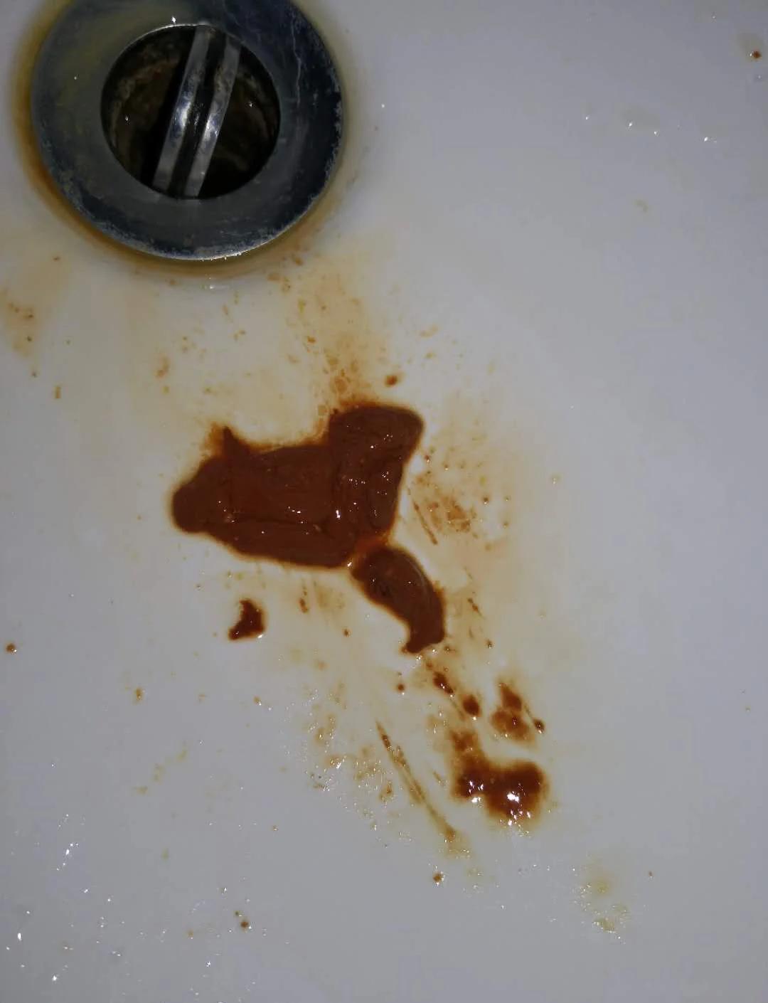 房事后第二天出现尿血