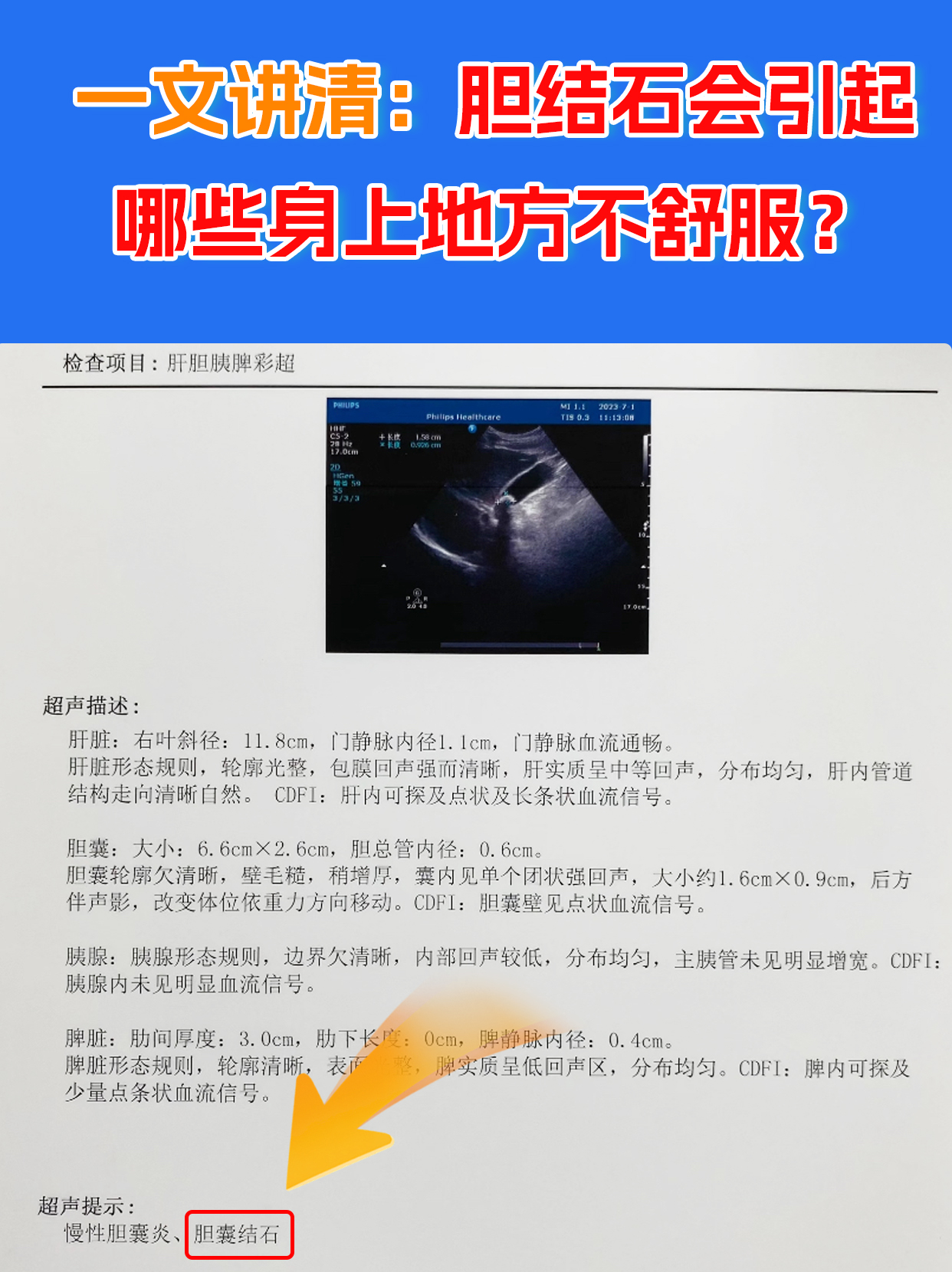 胆结石的症状和治疗方法?