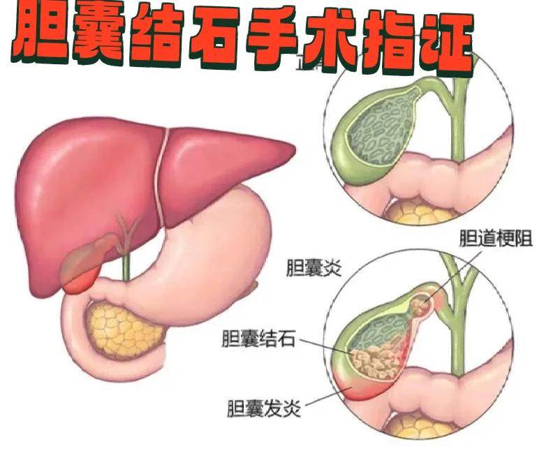 胆囊切除术后综合征如何治疗