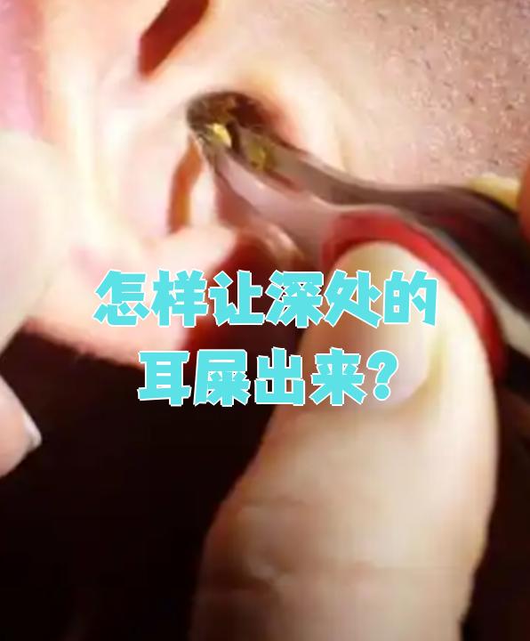 儿童耳朵里有硬耳屎怎么办