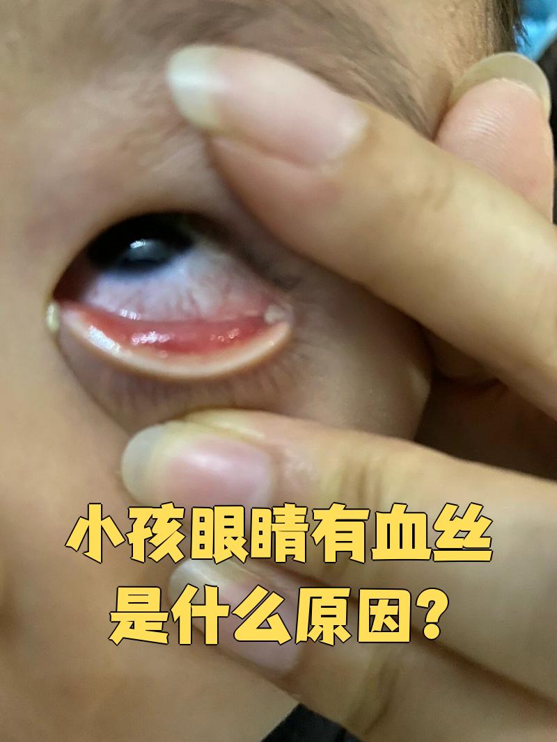 眼睛发黄有血丝为什么?