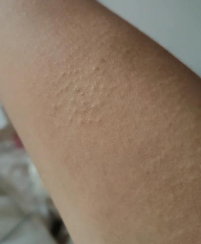 手臂上长了类似于鸡皮疙瘩.