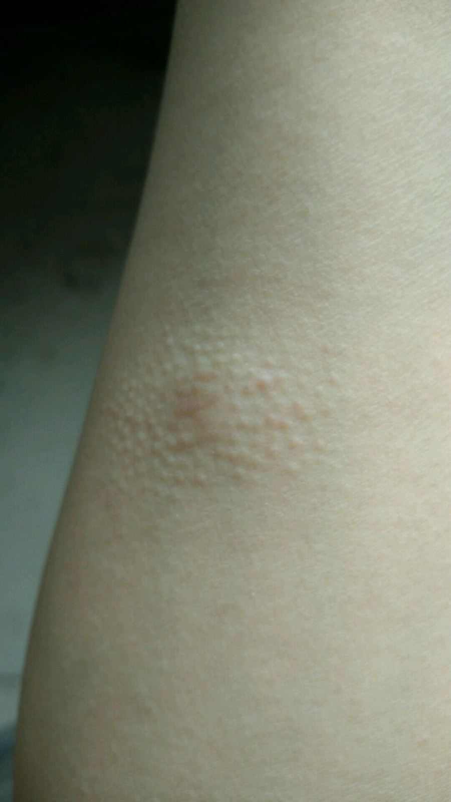 手臂上长了类似于鸡皮疙瘩.