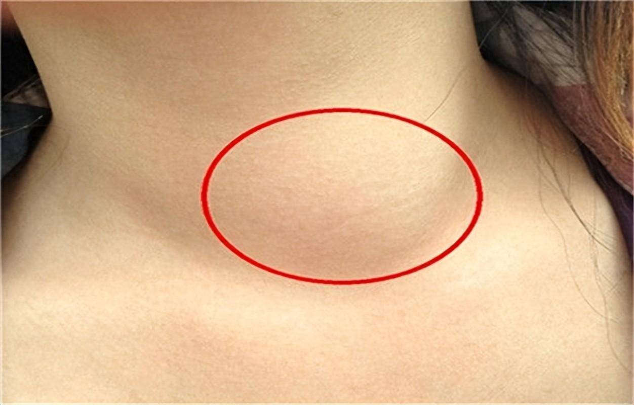 甲亢会传染吗,有什么症状