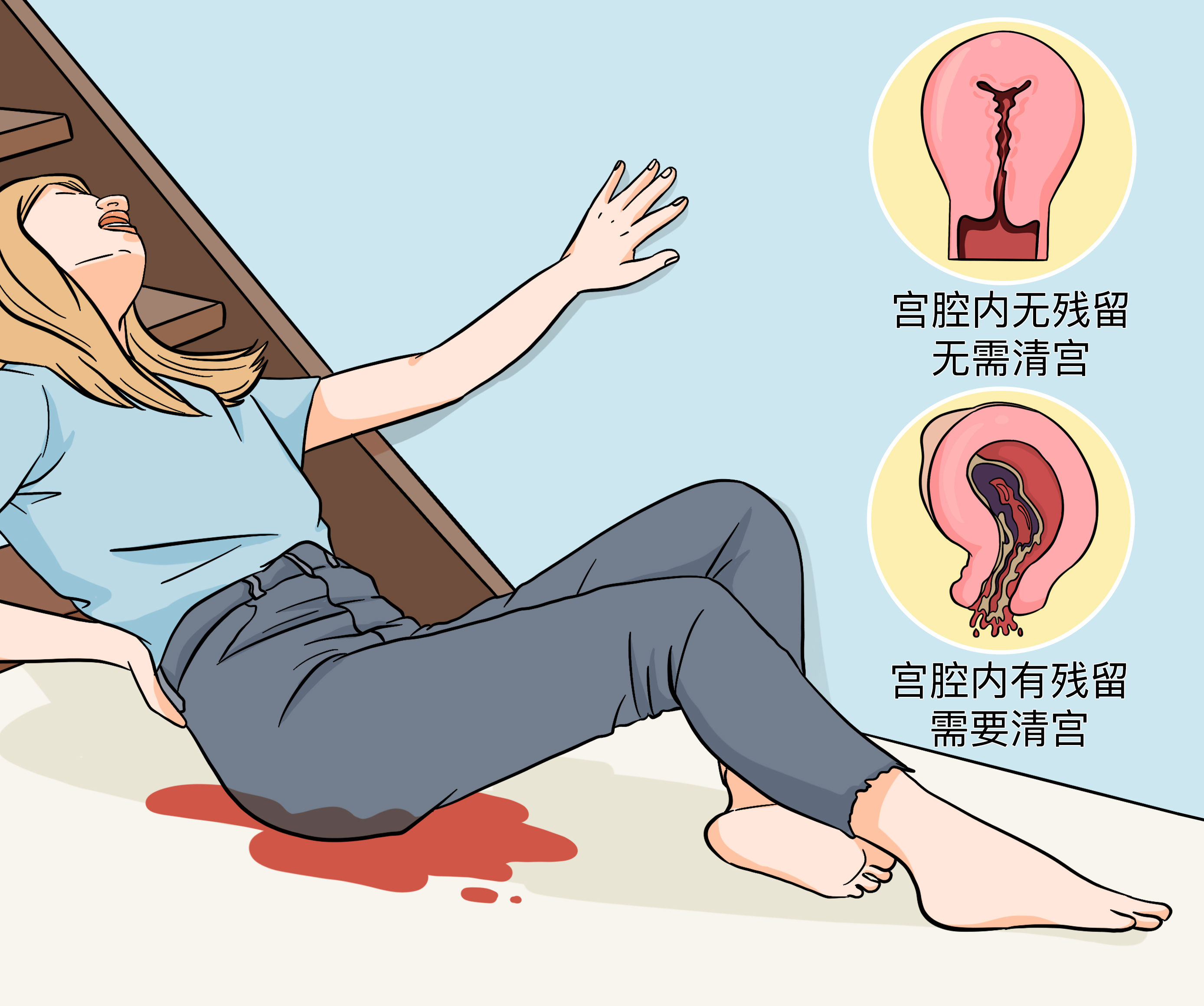 先兆流产还用做人流吗