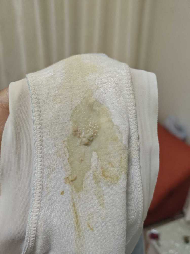 孕初期白带发黄