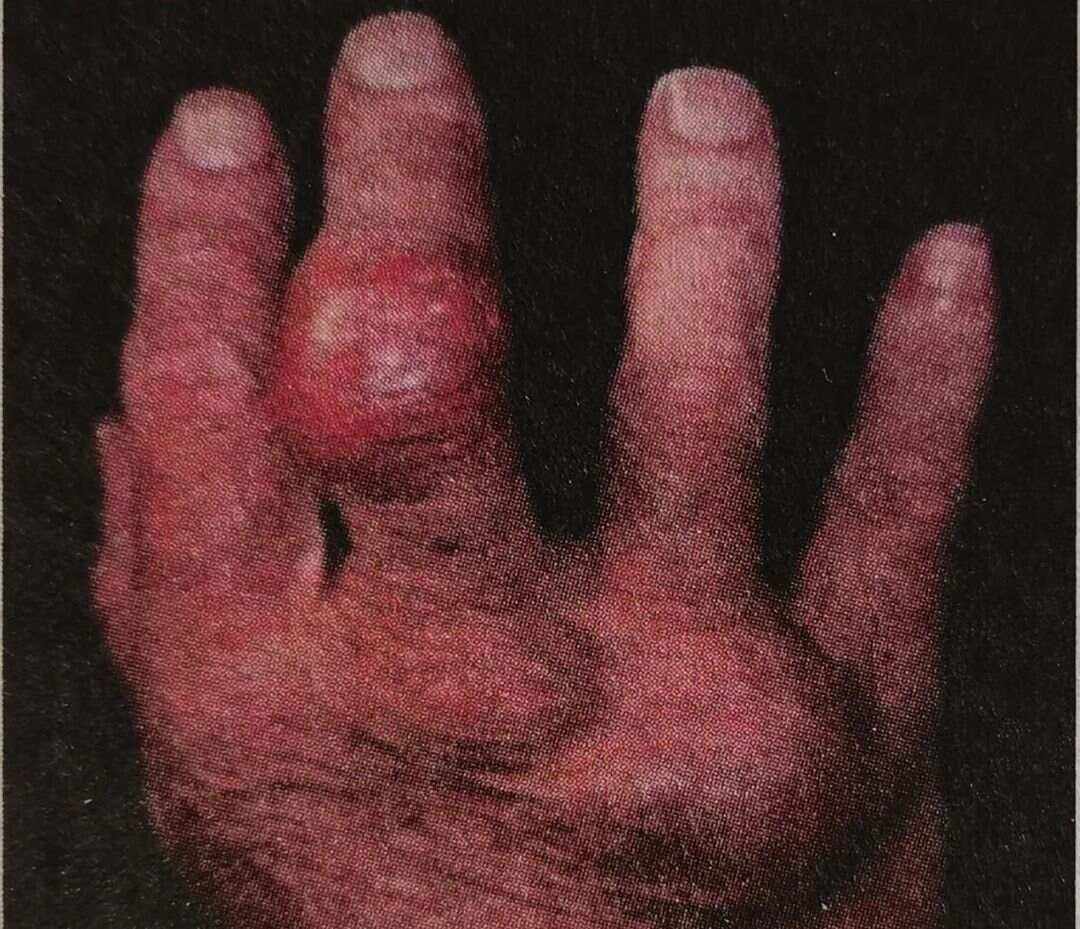 什么是甲状旁腺功能亢进症