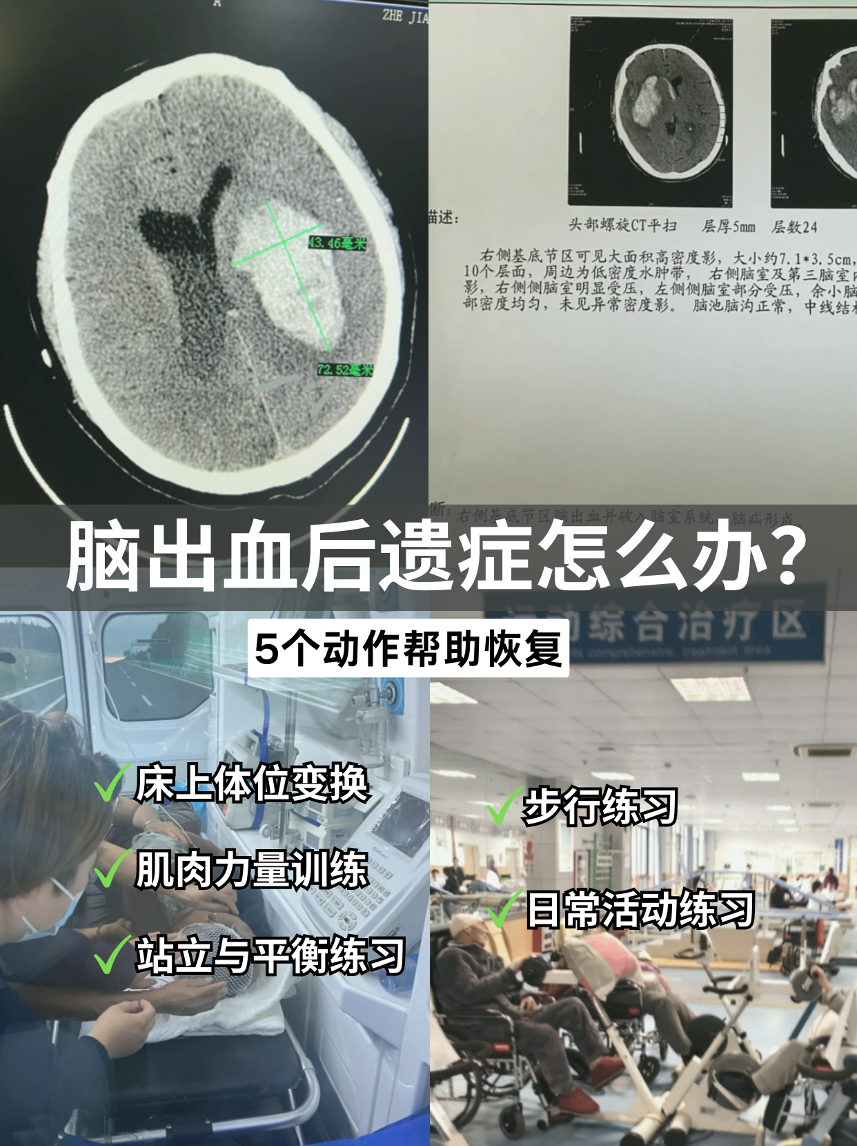 脑干出血会昏迷多久