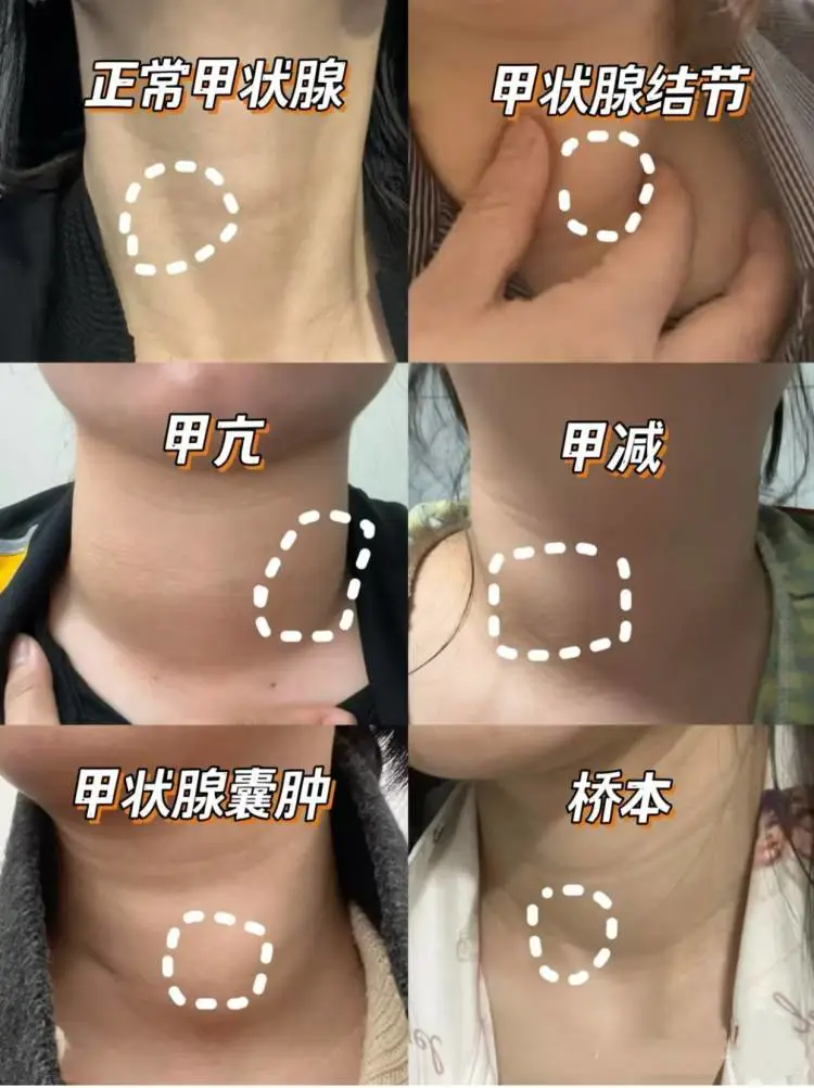 甲状腺结节的危害