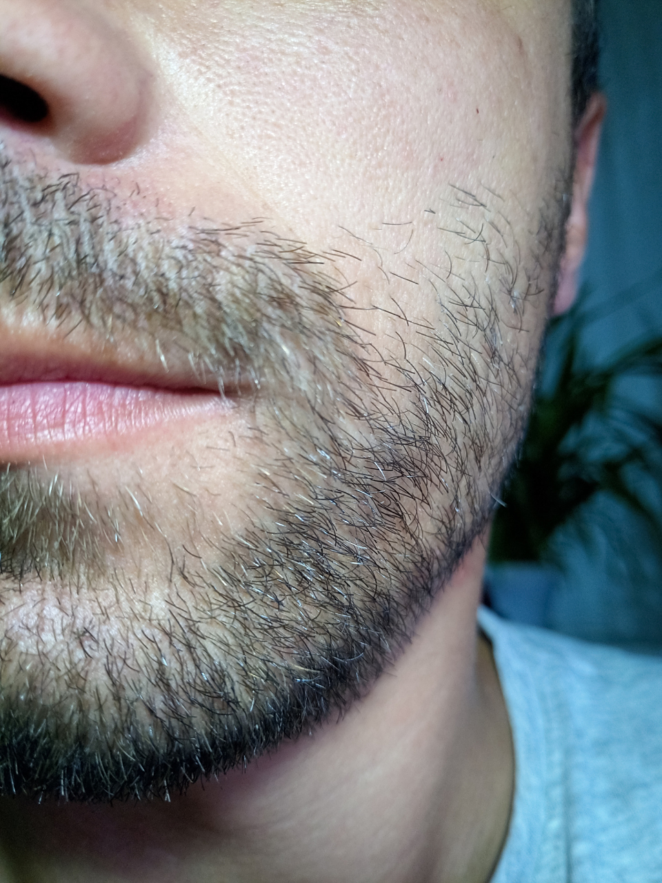 脸上长毛怎么永久去掉