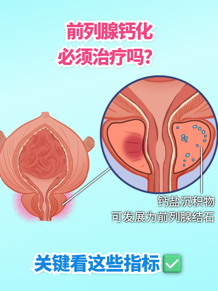 前列腺钙化灶是什么意思?..