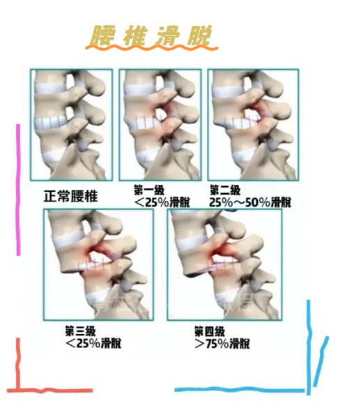 腰椎滑脱手术后遗症有哪些