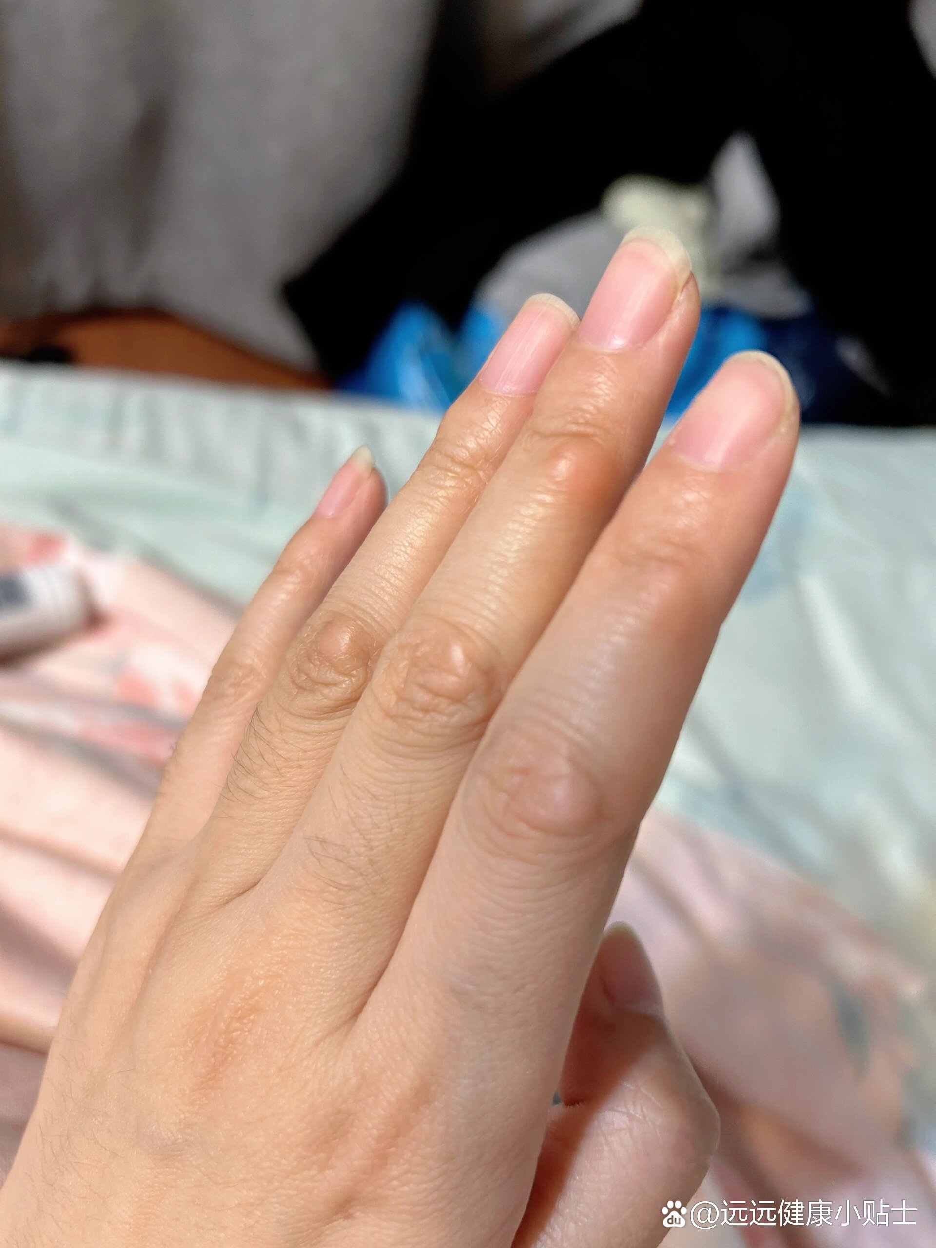 手上长了个硬疙瘩