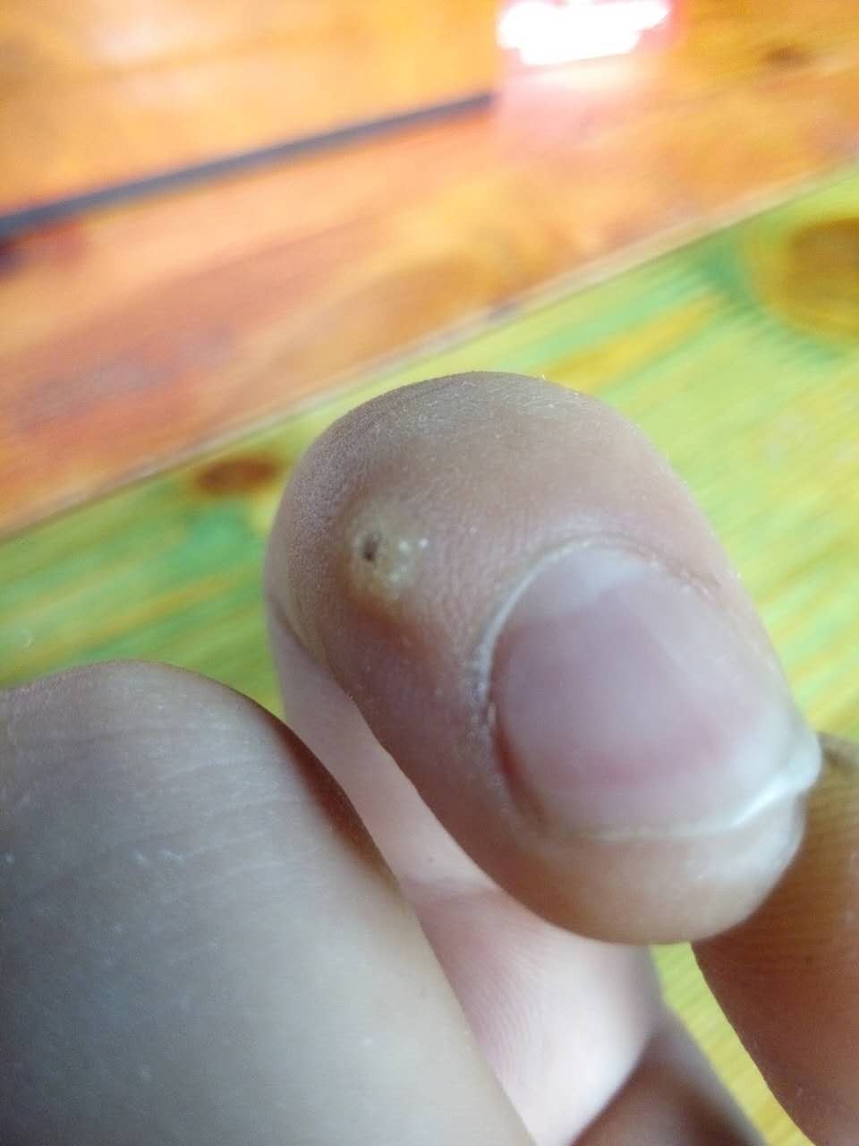 手上长了个硬疙瘩