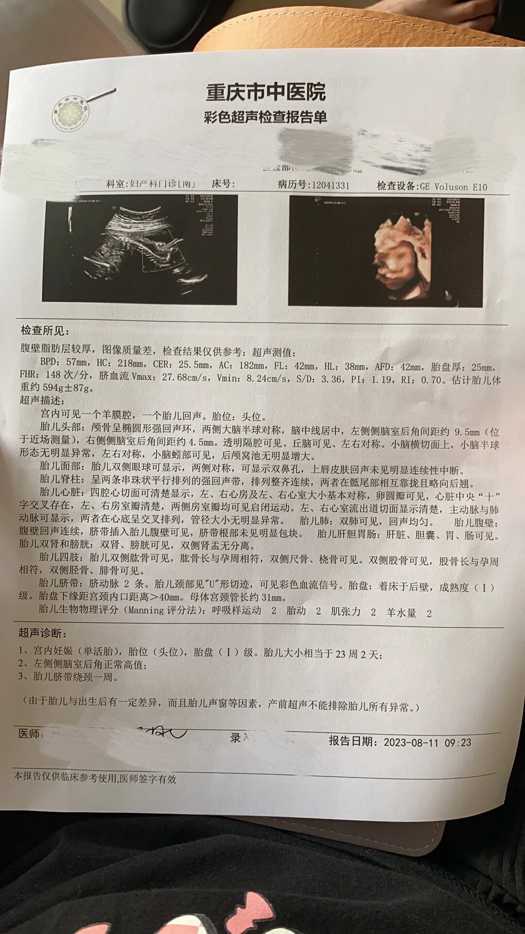 侧脑室宽度正常值是多少