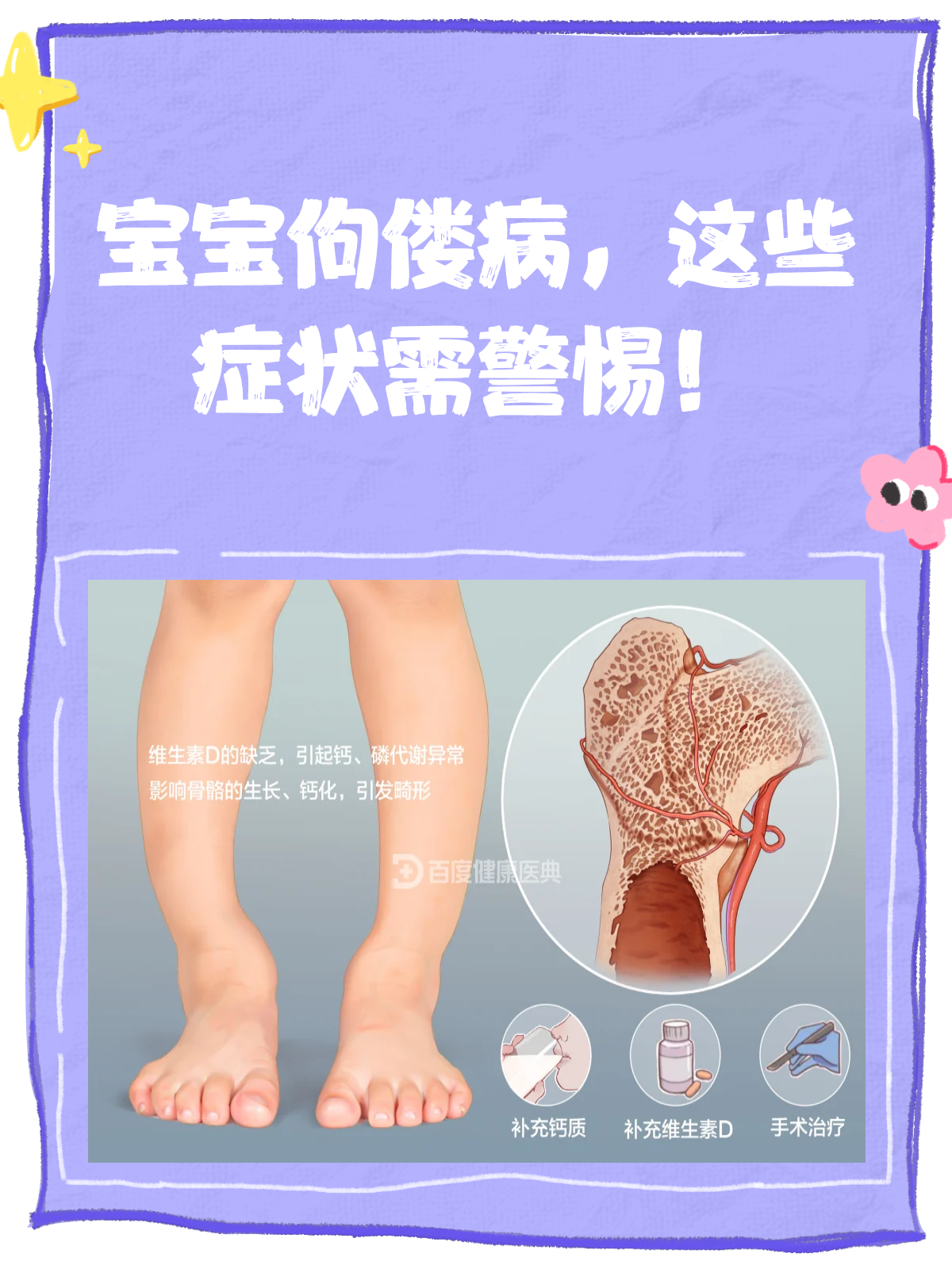 4岁小孩佝偻病有鸡胸怎么办